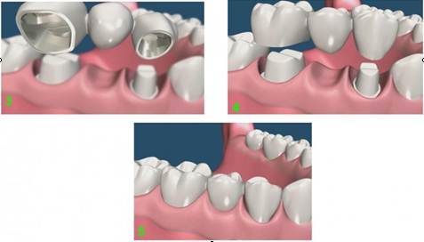 Установка металлокерамических коронок