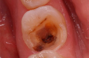 Фото пульпита зуба