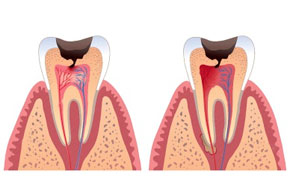 Схема развития пульпита зуба